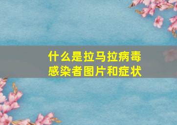 什么是拉马拉病毒感染者图片和症状