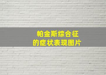 帕金斯综合征的症状表现图片