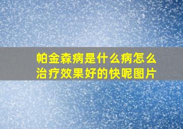 帕金森病是什么病怎么治疗效果好的快呢图片