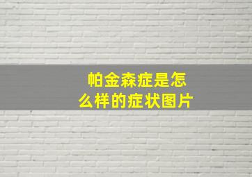 帕金森症是怎么样的症状图片