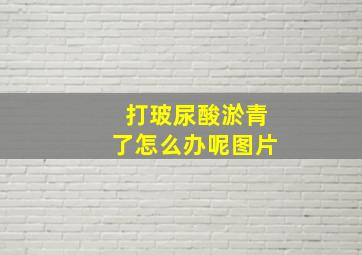 打玻尿酸淤青了怎么办呢图片