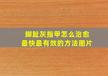 脚趾灰指甲怎么治愈最快最有效的方法图片